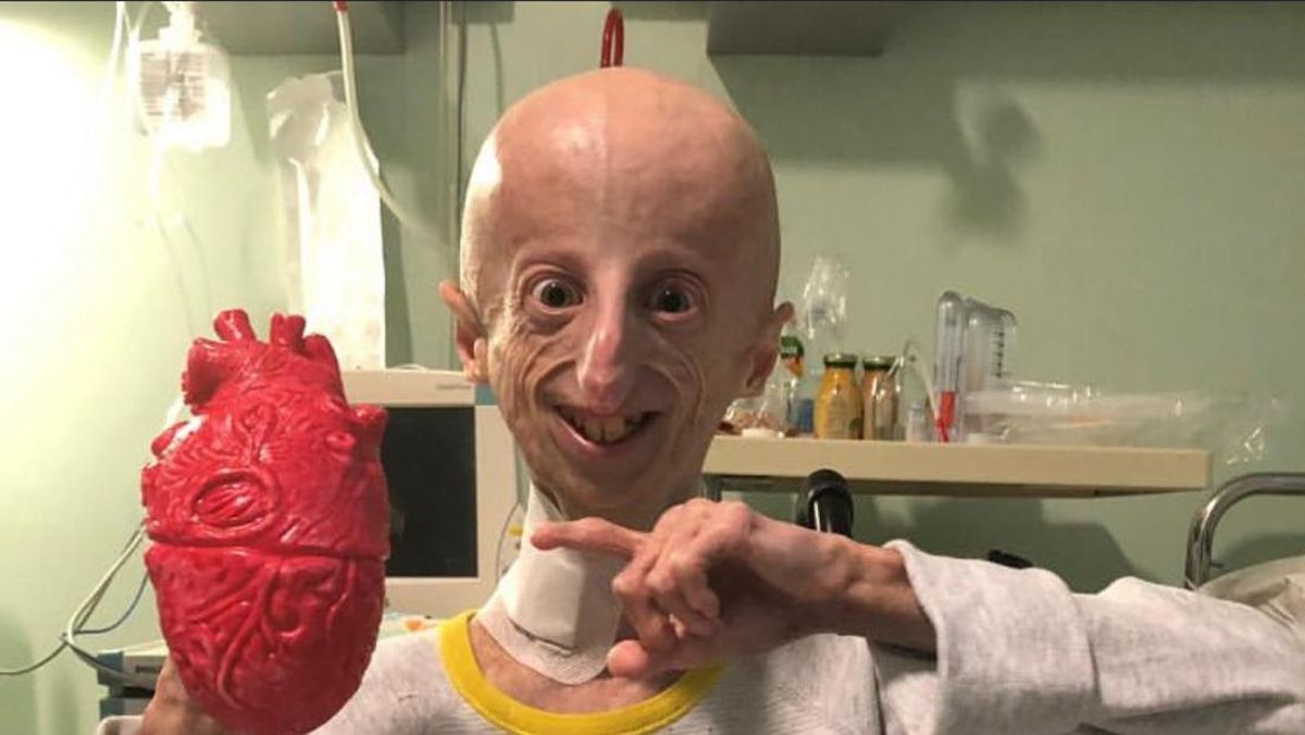 Memahami Progeria: Penyakit Langka yang Mengakibatkan Kepergian Sammy Basso